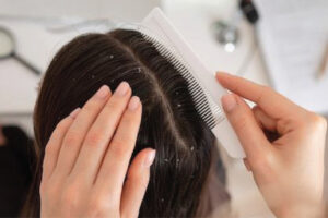 Dandruff  Treatment