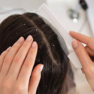 Dandruff Treatment
