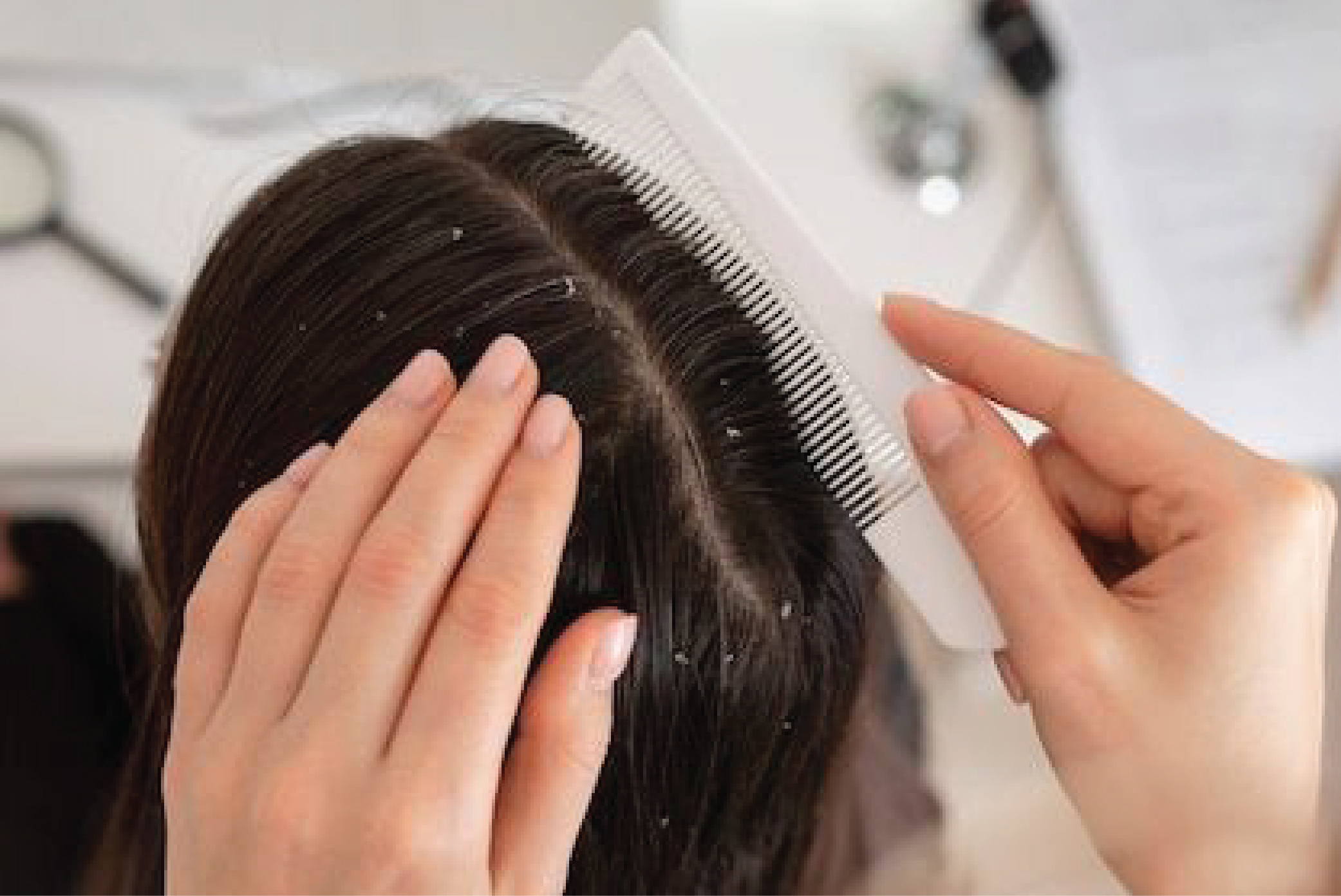 Dandruff Treatment